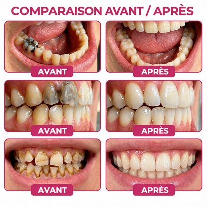 Glimmerly® 🍁💖DenPerm🎉— Gel Réparateur de l’Émail Naturel pour Caries, Dents Sensibles & Émail Fragilisé
