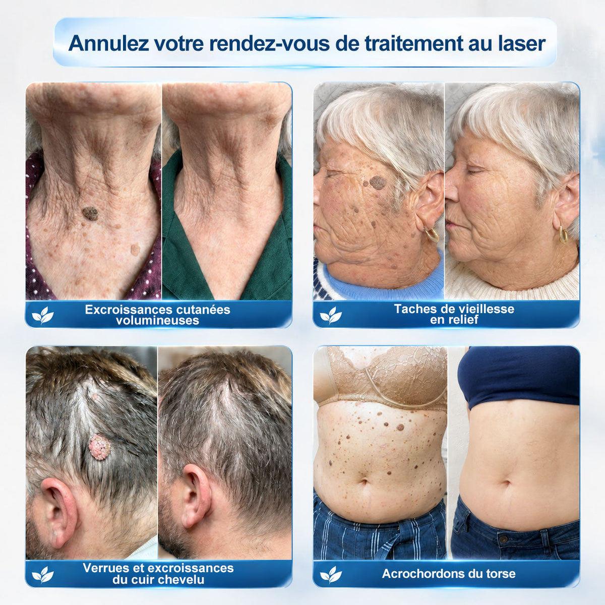 Boutique officielle de la marque 𝐏i𝐜𝐝o® 🍈💖7 Jours Effaceur de taches et d’excroissances cutanées(Zéro douleur, zéro cicatrice – Roller)
