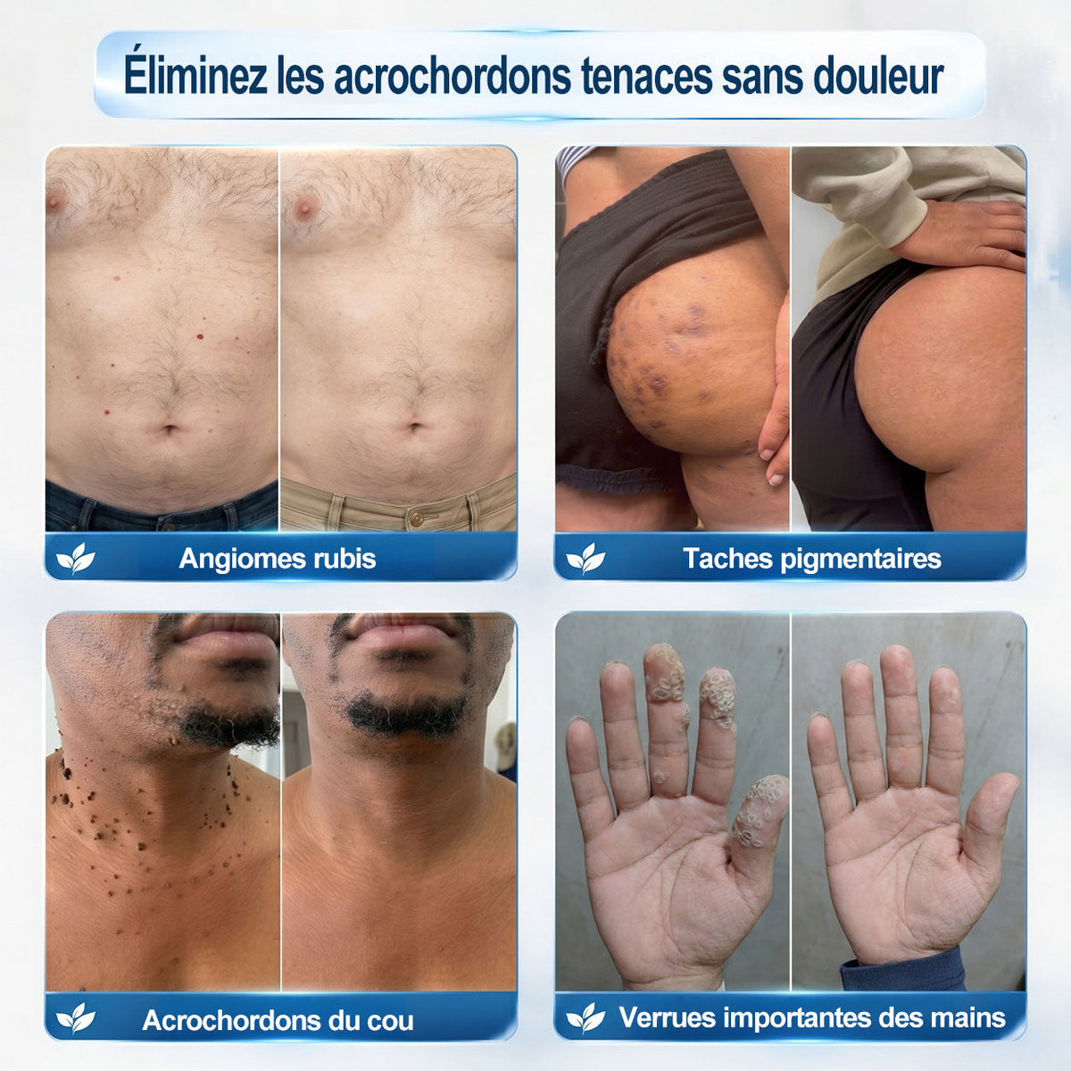 Boutique officielle de la marque 𝐏i𝐜𝐝o® 🍈💖7 Jours Effaceur de taches et d’excroissances cutanées(Zéro douleur, zéro cicatrice – Roller)