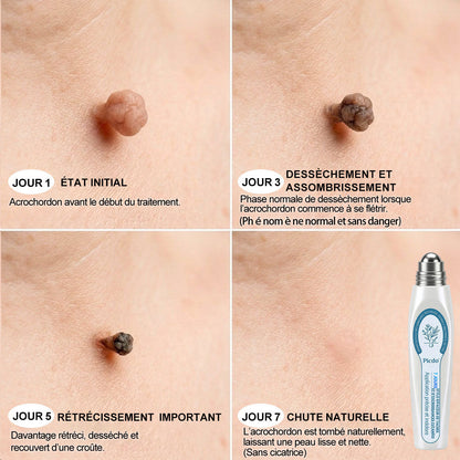 Boutique officielle de la marque 𝐏i𝐜𝐝o® 🍈💖7 Jours Effaceur de taches et d’excroissances cutanées(Zéro douleur, zéro cicatrice – Roller)